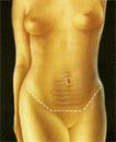 Cirug&iacute;a de abdomen (Dermolipectom&iacute;a) 