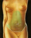 Cirug&iacute;a de abdomen (Dermolipectom&iacute;a) 