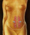 Cirug&iacute;a de abdomen (Dermolipectom&iacute;a) 