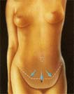 Cirug&iacute;a de abdomen (Dermolipectom&iacute;a) 