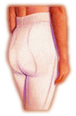 Lipoaspiraci&oacute;n
