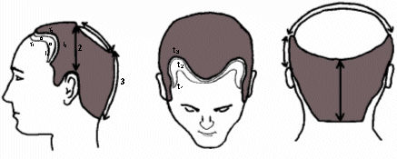 3 clasificaciones principales para los patrones de alopecia masculina