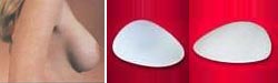Implantes anat&oacute;micos