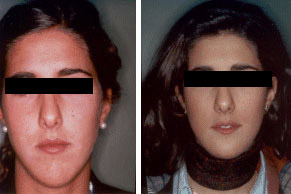 Cirug&iacute;a de ment&oacute;n y p&oacute;mulos (Perfiloplastia) Antes y Despues